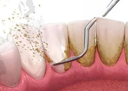 牙烟渍洗牙能洗掉吗?牙齿烟渍洗牙用超声波还是喷砂好?