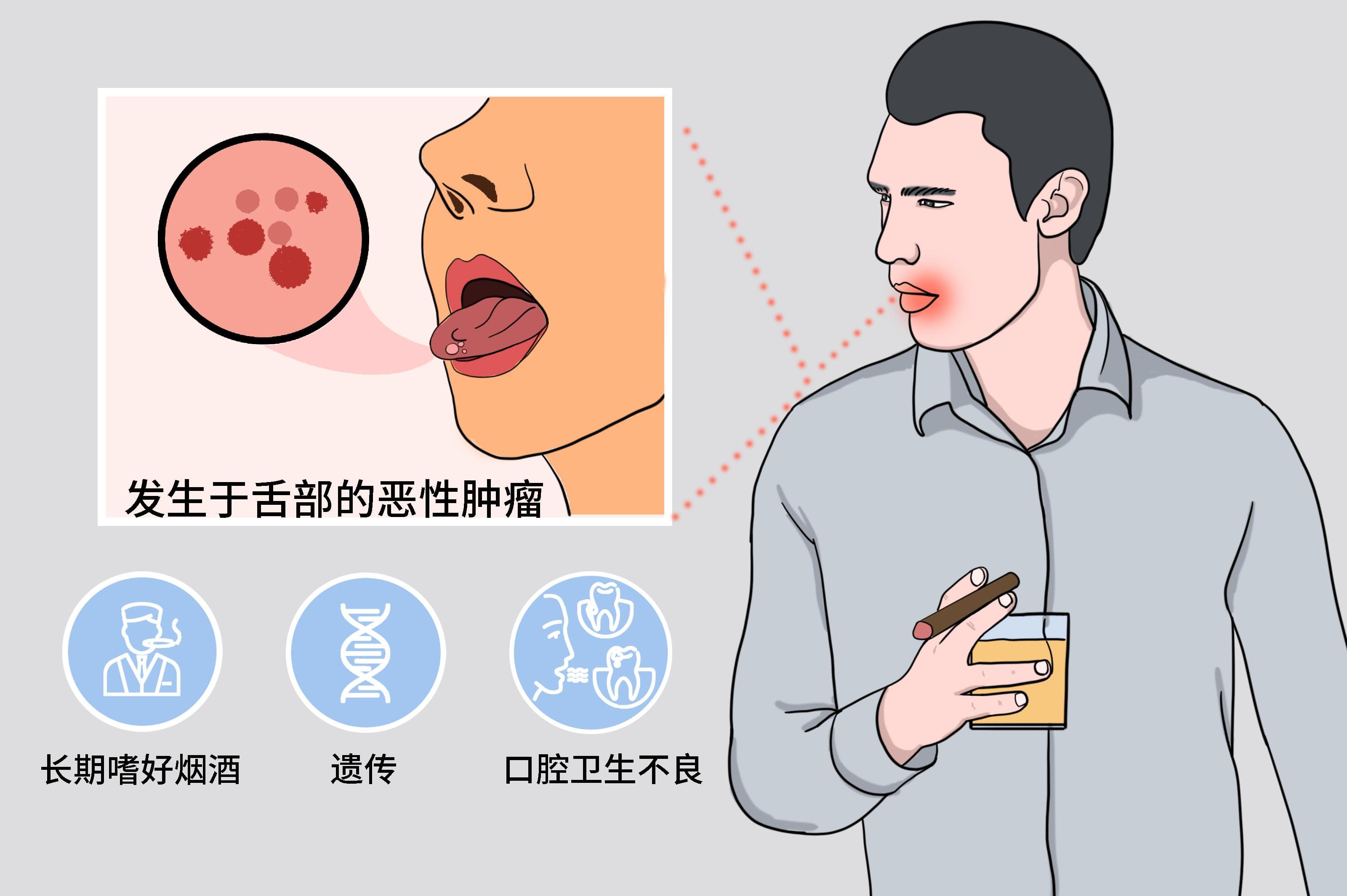 舌癌早期有6大征兆