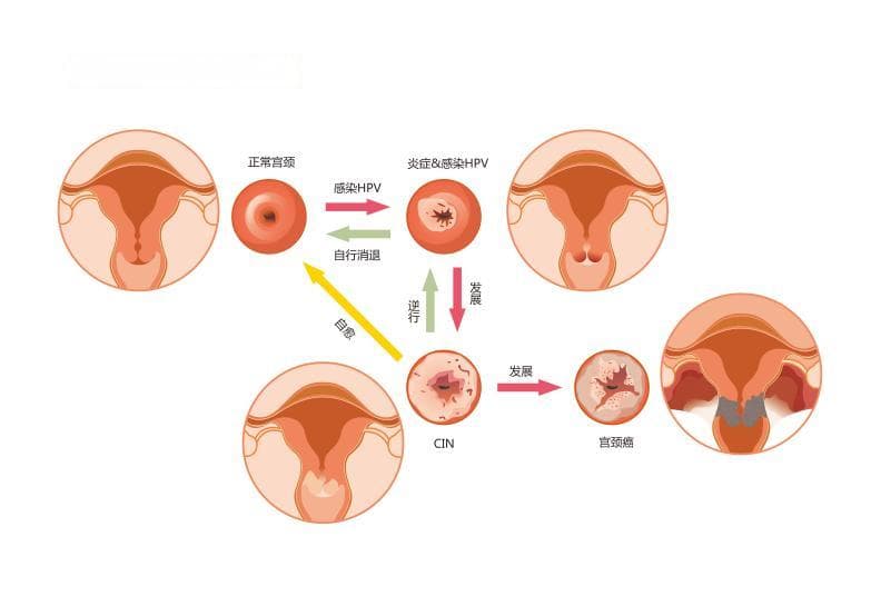 女性常见的癌症，做哪些检查可以提前查出？