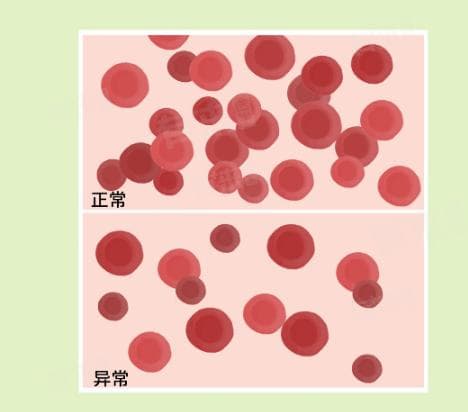 为什么会出现血小板减少？