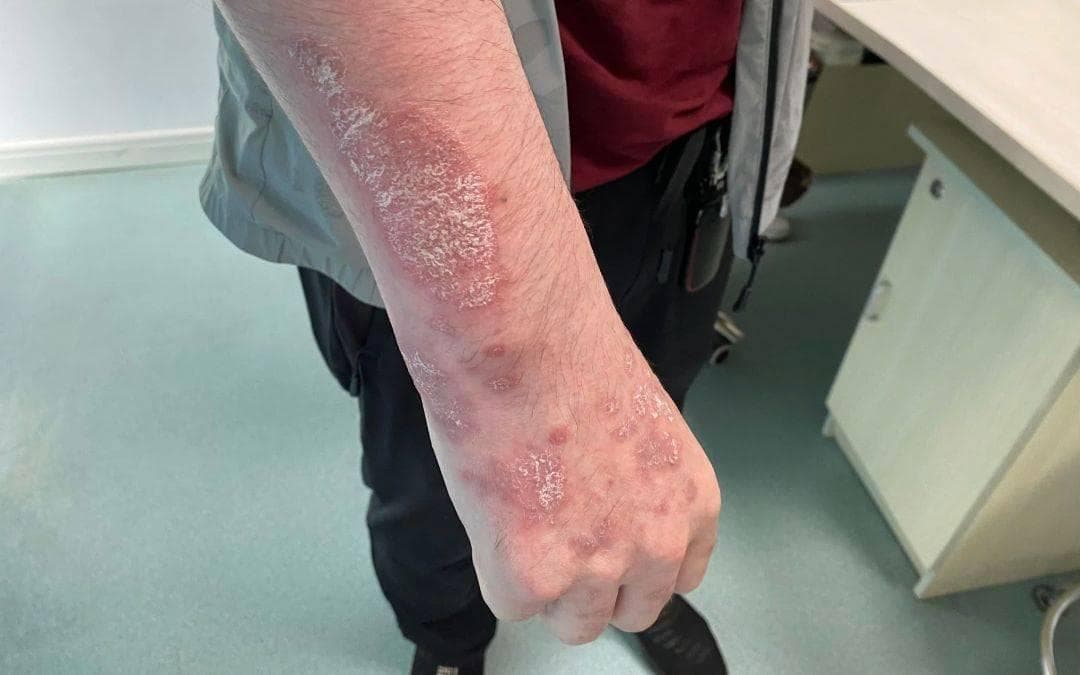 银屑病患者洗澡多久一次，医生把细节都讲清楚