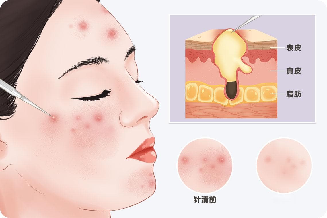 针清完多久能化妆