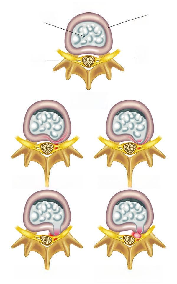 腰椎峡部裂的5种保守治疗方法