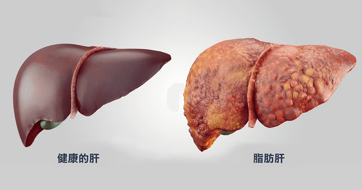 脂肪肝如何形成？教你改善与治疗