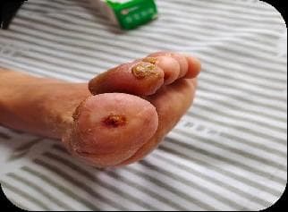 纯中医疗法让7旬糖尿病足老人免于截肢！