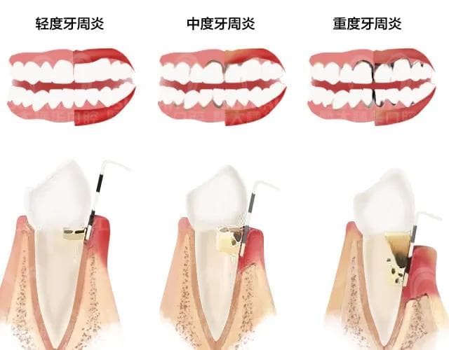 牙周炎，多少人的难「炎」之隐！