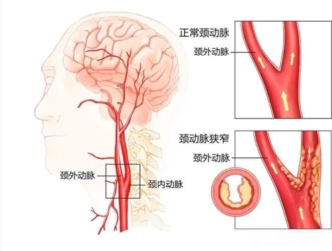 颈动脉狭窄小知识