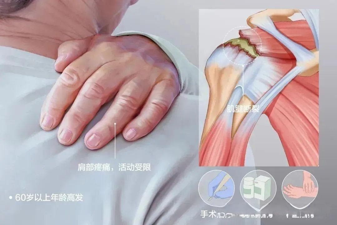 【盘点】肩关节疼痛常见的 7 种疾病