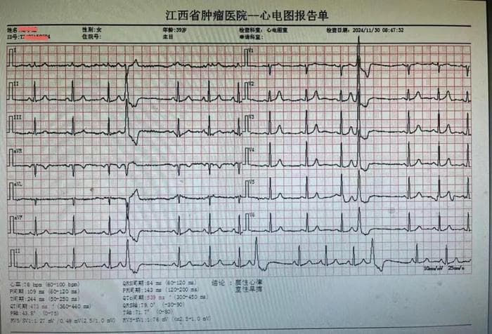 室性早搏的成因、症状与危害全解析