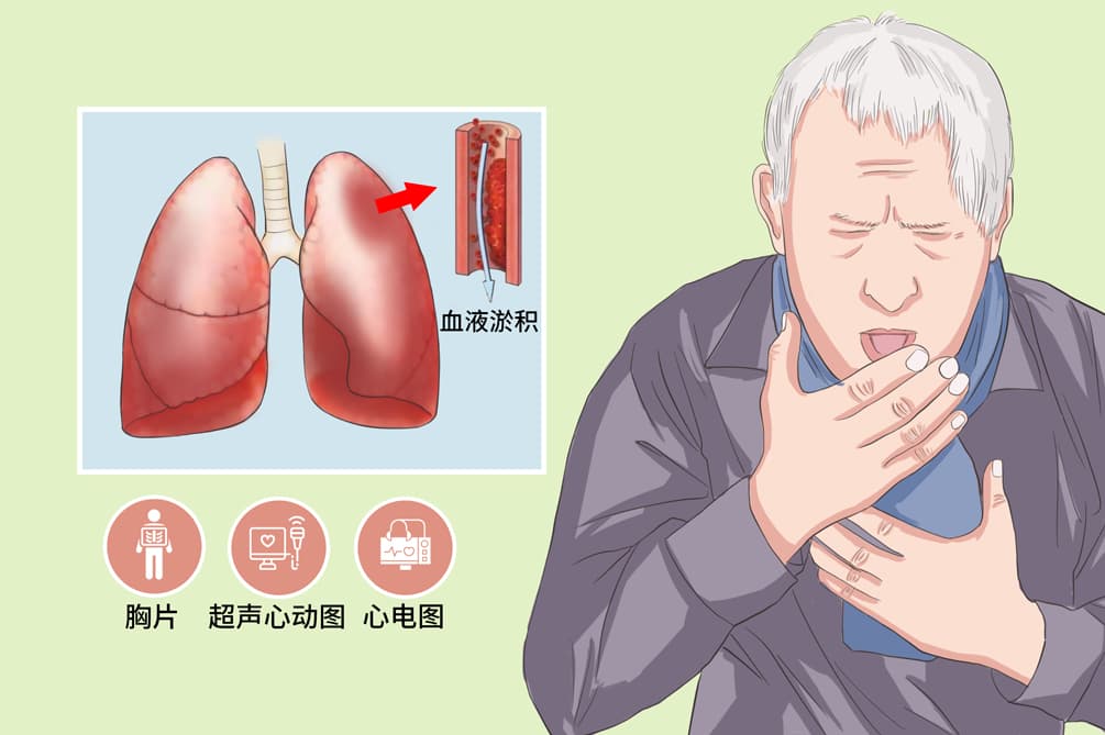 肺淤血：病因、症状、诊断与治疗全解析