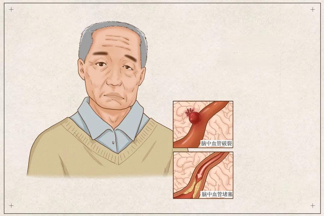 世界高血压日 | 从高血压到脑卒中，不可不知的那些事儿！