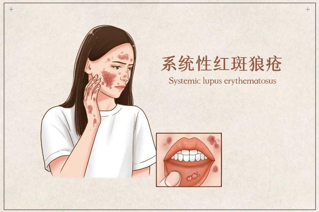 当红斑狼疮已经出现肾脏病变时，这些治疗要点尤其要注意
