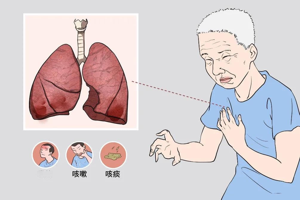下呼吸道感染：从病因到预防的全面解析