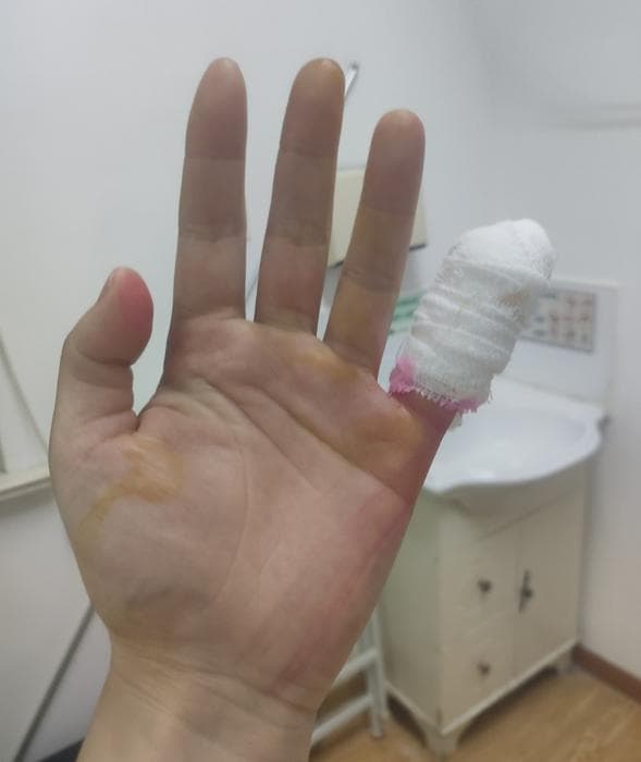 这些日常小伤口你处理对了吗？