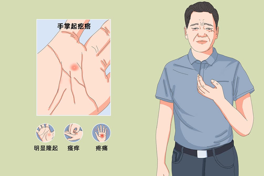手掌起小水泡要警惕了