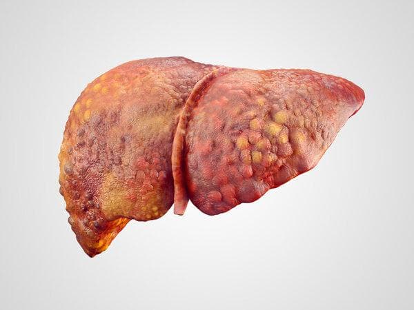 肝脏钙化灶的成因与治疗：从胆管结石到肝癌的全面解析