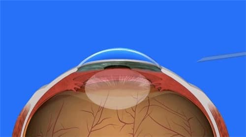 后发障打激光手术后遗症全解析：视力模糊、眩光、黄斑水肿等风险需警惕