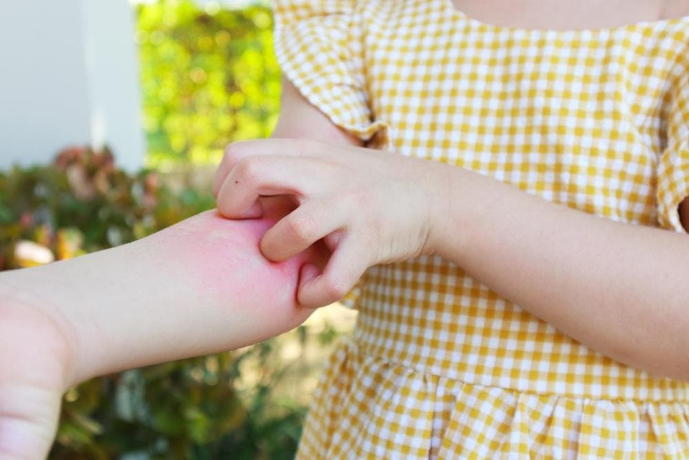 婴幼儿忽然过敏起疹怎么办？10大儿童皮肤病这样应对！