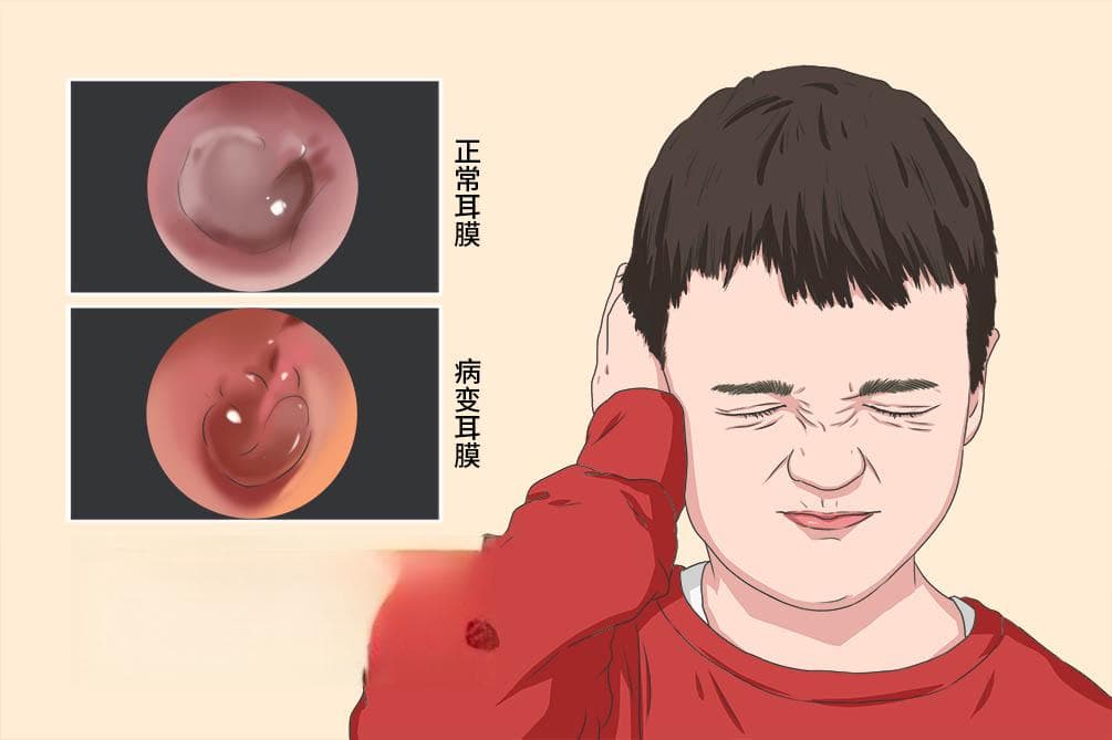 中耳炎自己能恢复吗