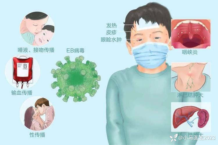 详解传染性单核细胞增多症：病因、诊断与治疗全解析
