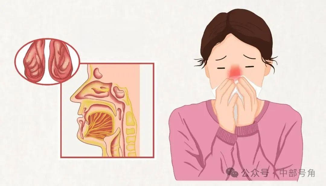 秋风起，鼻炎袭，你了解过敏性鼻炎吗？