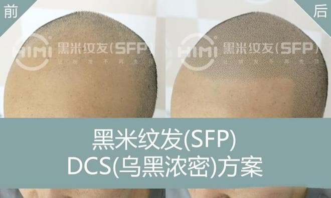 如何有效治疗脱发？实用建议与最新技术 —— 包括纹发