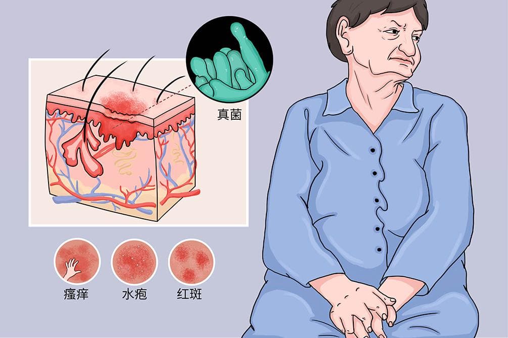 真菌感染：从症状到治疗的全面指南
