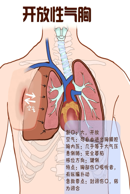 胸痛、咳嗽、呼吸不畅？关于这个病您不可不知的科普知识