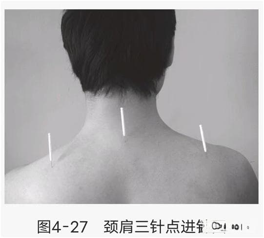 筋骨三针疗法定点定位(二十七)——颈肩三针点