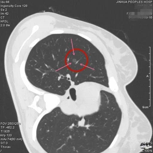 病例分享：肺磨玻璃结节术后病理是不典型增生，这刀白开了吗？