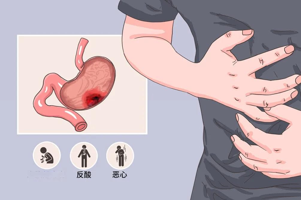 糜烂性胃炎的症状有哪些