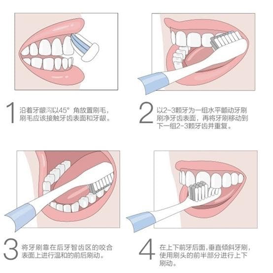 护牙保卫战！拒绝楔状缺损
