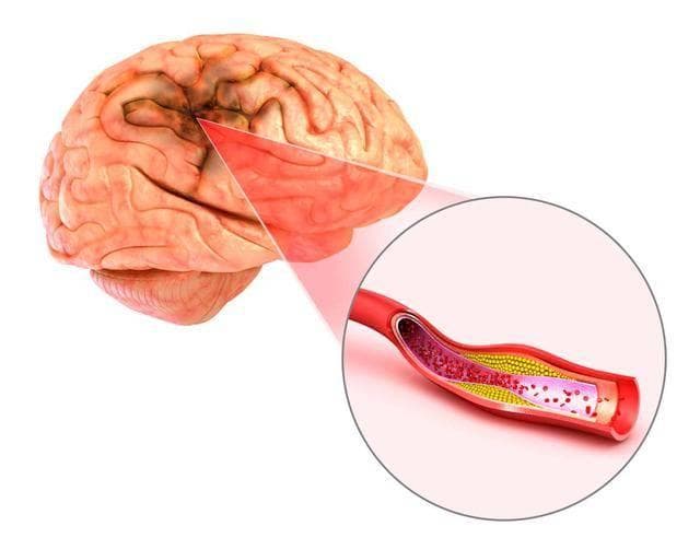 八成脑梗因栓子堵塞，高脂肪饮食加速血管病变
