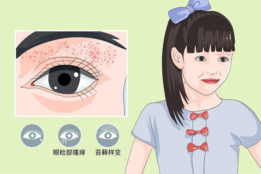 眼睑湿疹：症状、诊断与治疗全解析