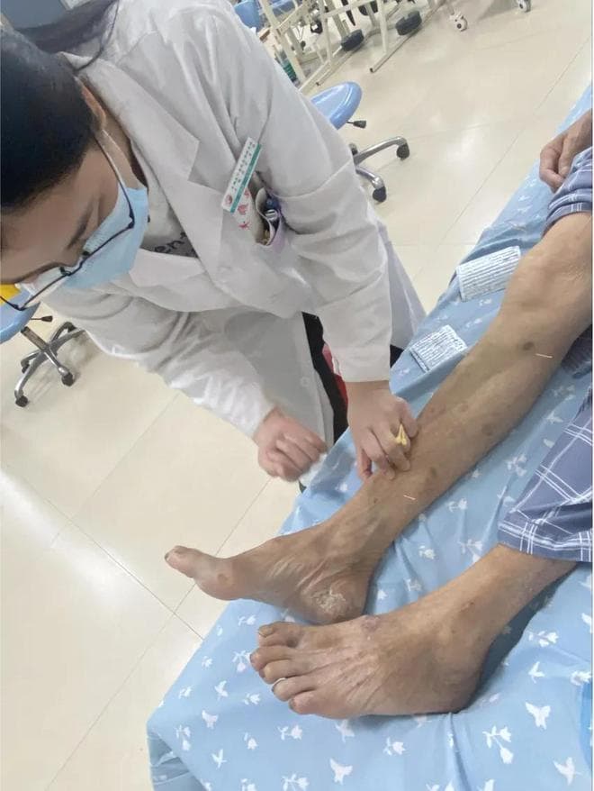 七旬老人中风后从卧床到行走，中医康复助力重获新生