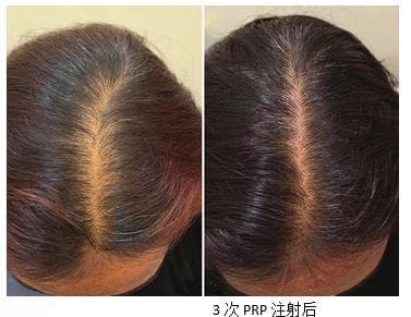 自体血液也能美肤？