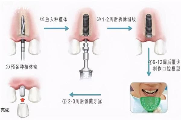 看牙需要多长时间？不同牙科治疗项目所需时间详解
