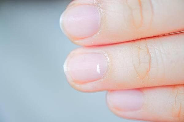 月牙变小，身体出问题了？指甲上的白斑、黑线要紧吗