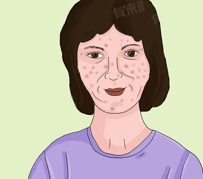 蝴蝶斑的形成原因及护理方法