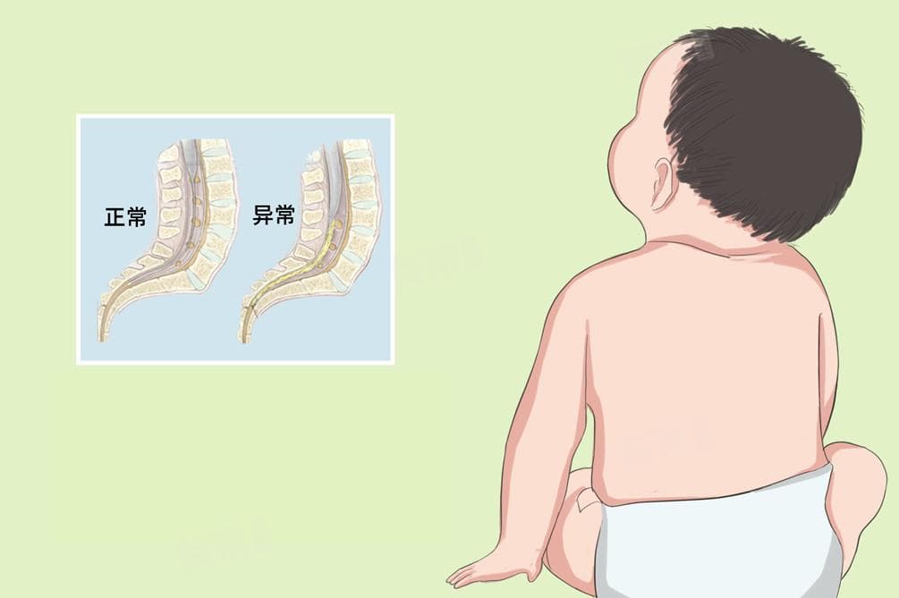 脊髓栓系是什么原因导致的