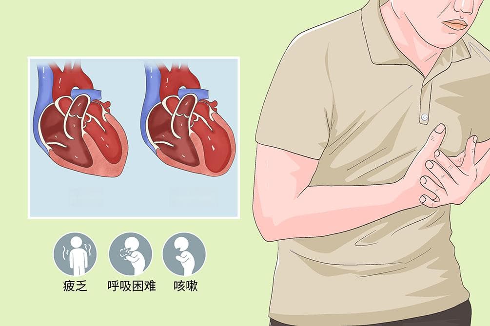 急性左心衰竭：病因、症状、诊断与治疗全解析