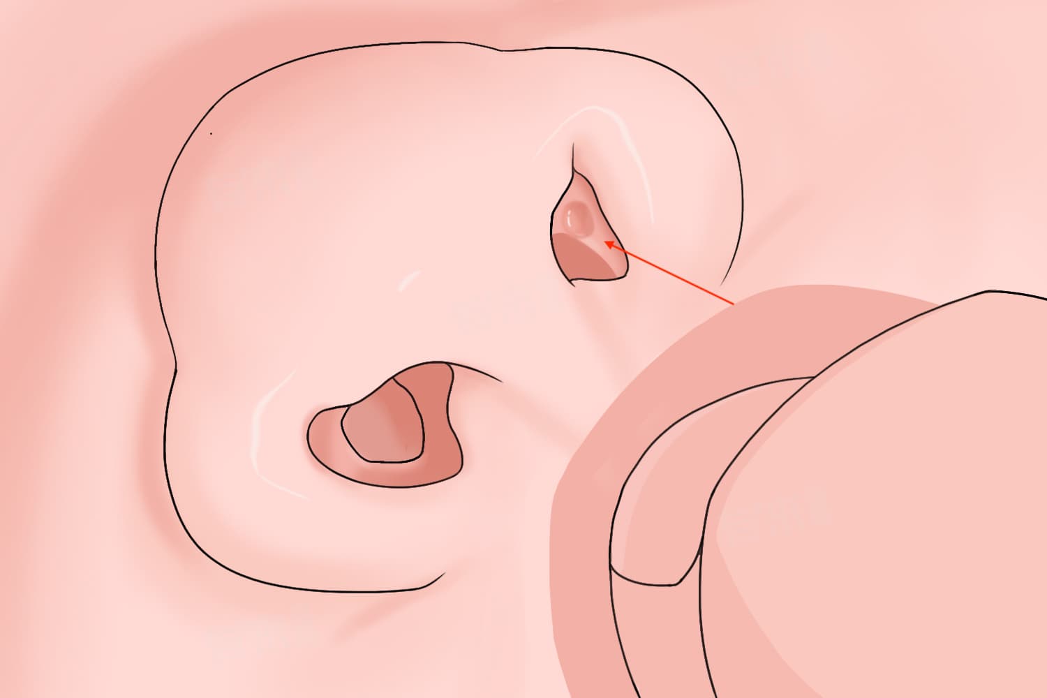孩子鼻子里面有个肉球是怎么回事