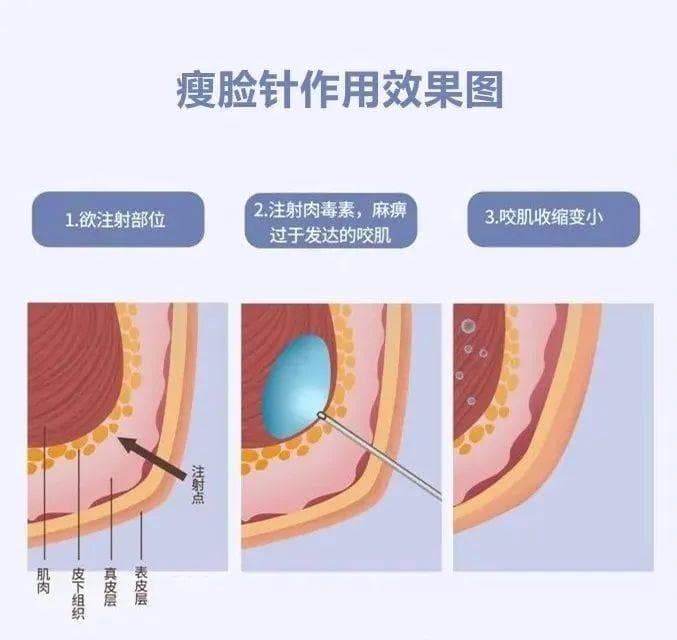 微整医生张国军：解析瘦脸针的原理、维持时间及注意事项