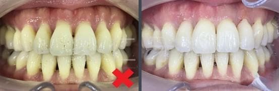 黑三角/牙缝过大问题是可以解决的吗？