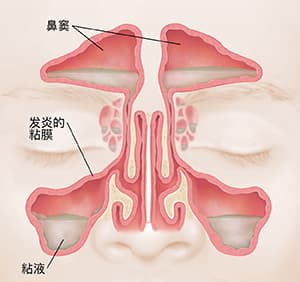 了解急性鼻窦炎