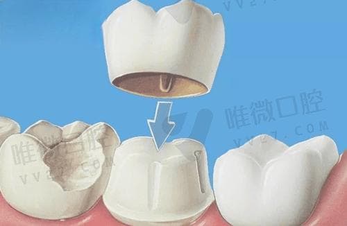 牙冠和嵌体哪个实用性强？补牙做牙冠好还是嵌体好？列出两者优缺点判断