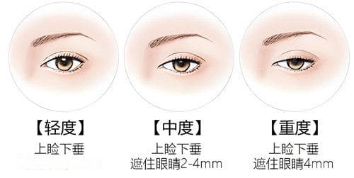 上睑下垂手术全攻略：三种方式、费用及恢复时间详解