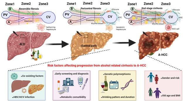 Hepatology：eG副主编高斌教授综述：酒精性肝癌最新进展与未来研究方向