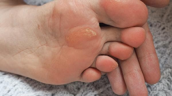 成人扁平足怎么矫正