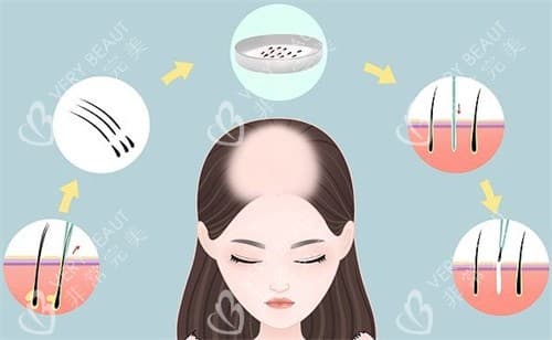 美丝沛是智商税吗？碧莲盛用的美丝沛疗法解析